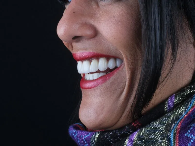 Lentes de Contato Dental